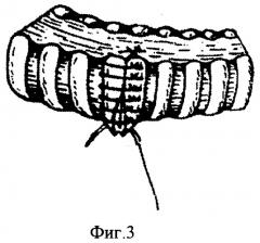 Способ обработки культи главного бронха при пневмонэктомии (патент 2354306)