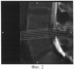 Способ диагностики стенозирующих процессов позвоночного канала и дурального мешка на поясничном уровне (патент 2483675)