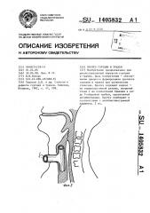 Протез гортани и трахеи (патент 1405832)