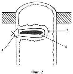 Способ создания резервуарно-клапанной тонкокишечной стомы (патент 2375973)