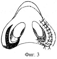 Способ коррекции основания и крыльев носа (патент 2251979)