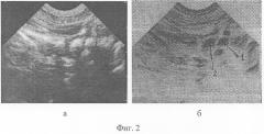 Способ ультрасонографической диагностики натальных повреждений сустава крювелье (патент 2282398)