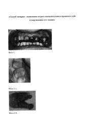 Способ экспресс-выявления острого воспалительного процесса в зубе и окружающих его тканях (патент 2644688)