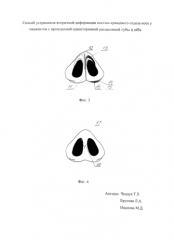 Способ устранения вторичной деформации костно-хрящевого отдела носа у пациентов с врожденной односторонней расщелиной губы и нёба (патент 2580663)