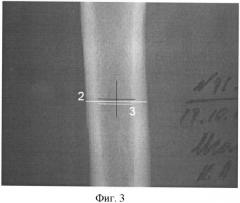 Способ цифровой компьютерной оценки рентгенограмм в диагностике остеопороза (патент 2366363)