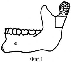 Способ хирургического лечения костного анкилоза височно-нижнечелюстного сустава и недоразвития нижней челюсти (патент 2411921)