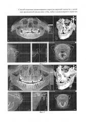 Способ пластики альвеолярного отростка верхней челюсти у детей при врожденной расщелине губы, неба и альвеолярного отростка (патент 2594945)