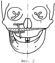 Способ устранения недоразвития и/или дефекта нижней челюсти, сочетающегося с недоразвитием верхней челюсти (патент 2267303)