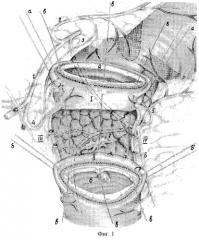 Способ хирургического лечения осложненных низких дуоденальных язв (патент 2257166)