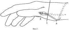 Способ восстановления активного противопоставления 1 пальца кисти (патент 2306888)
