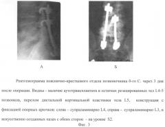 Способ инструментальной фиксации пояснично-крестцового отдела при воспалительных заболеваниях позвоночника (патент 2271165)