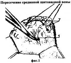 Способ экстрафасциального удаления доли щитовидной железы (патент 2357684)