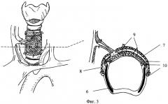 Способ замещения окончатых дефектов трахеи и гортани (патент 2440789)