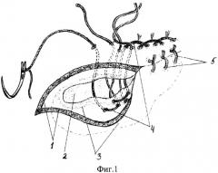Способ оперативного лечения пупочной грыжи у лошадей (патент 2540364)