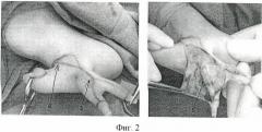 Способ устранения врожденной сгибательной контрактуры локтевого сустава, обусловленной дефицитом мягких тканей в области локтевого сгиба, при отсутствии кисти и наличии рудиментарных пальцев на области недоразвитого предплечья (патент 2441613)