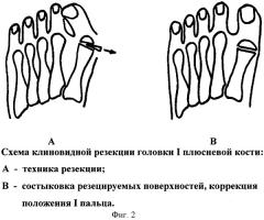 Способ лечения поперечного плоскостопия (патент 2297803)