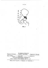 Устройство для фиксации фрагментов кости (патент 1113110)