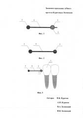 Замковое крепление зубного протеза куретовых-зеленских (патент 2595007)