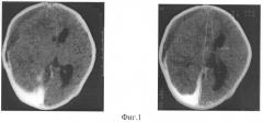 Способ лечения субдуральной гематомы у детей грудного возраста (патент 2322195)