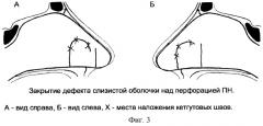 Способ пластического закрытия субтотальных перфораций перегородки носа у детей (патент 2246910)