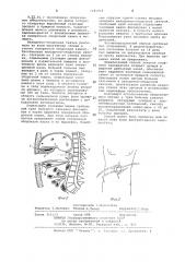 Способ лечения гнойного панкреатита (патент 1091918)