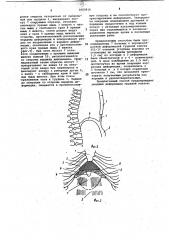 Способ оперативного лечения воронкообразной грудной клетки (патент 1053816)