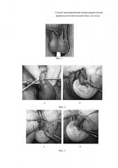 Способ малоинвазивной микрохирургической варикоцелэктомии мошоночным доступом (патент 2663074)