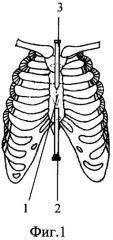 Способ лечения врожденной воронкообразной деформации грудной клетки у детей (патент 2283052)