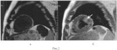 Способ оценки эффективности радиочастотной аблации почечных артерий у больных с резистентной артериальной гипертензией (патент 2554212)