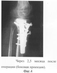 Способ остеосинтеза с использованием костной аллопластики (патент 2299028)