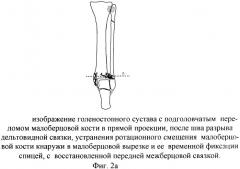 Способ оперативного лечения подголовчатых переломов малоберцовой кости при переломовывихах в голеностопном суставе (патент 2369341)