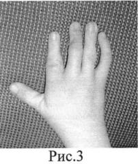 Способ лечения врожденной разгибательной контрактуры лучезапястного сустава в сочетании со сгибательными контрактурами и ульнарной девиацией трехфаланговых пальцев на уровне пястно-фаланговых суставов у детей с артрогрипозом (патент 2553941)