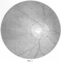 Способ диагностики атрофии зрительного нерва (патент 2282390)