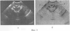 Способ ультрасонографической диагностики натальных повреждений сустава крювелье (патент 2282398)