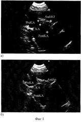 Способ ультразвуковой диагностики коарктации аорты (патент 2244512)