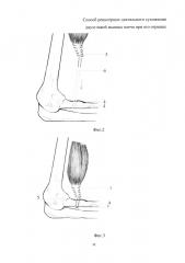 Способ реинсерции дистального сухожилия двуглавой мышцы плеча при его отрывах (патент 2663384)