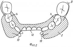 Многофункциональный двучелюстной ортодонтический аппарат-протез для лечения мезиального прикуса (патент 2307620)