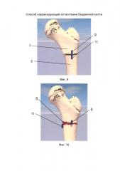 Способ корригирующей остеотомии бедренной кости (патент 2656018)