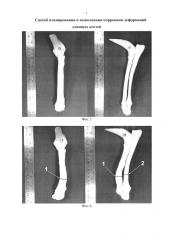 Способ планирования и выполнения коррекции деформаций длинных костей (патент 2641840)