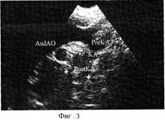 Способ ультразвуковой диагностики коарктации аорты (патент 2244512)