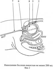 Способ надлобковой цистостомии при внебрюшинном нарушении целостности стенок мочевого пузыря (патент 2522385)