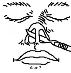 Способ коррекции комбинированных деформаций наружного носа орально-преддверным оперативным доступом (патент 2243733)