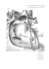 Способ профилактики тампонады сердца после кардиохирургических вмешательств (патент 2647626)