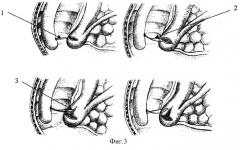 Способ нетипичной эндоскопической папиллотомии (патент 2258480)