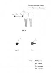 Замковое крепление зубного протеза куретовых-зеленских (патент 2595007)