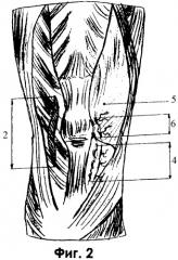 Способ теномиопластической фиксации надколенника с помощью артроскопической техники (патент 2368343)