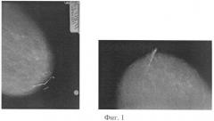 Способ чрескожной предоперационной маркировки пораженного протока молочной железы (патент 2336022)