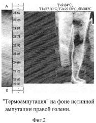 Тепловизионный комплекс для визуализации тепловых полей и измерения температур пациентов с дистальной гипотермией (патент 2432896)