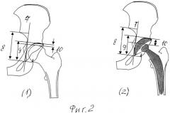 Способ рентгенологического определения относительных изменений длины конечности на уровне тазобедренного сустава (патент 2500351)