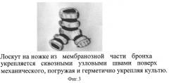Способ герметизации культи бронха (патент 2310397)